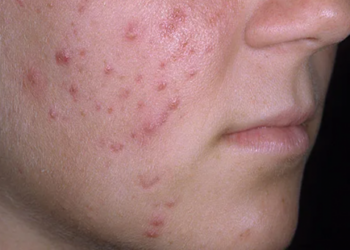 Five remedies for pimples, acne, dark spots